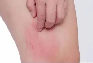 湿疹8 湿疹8